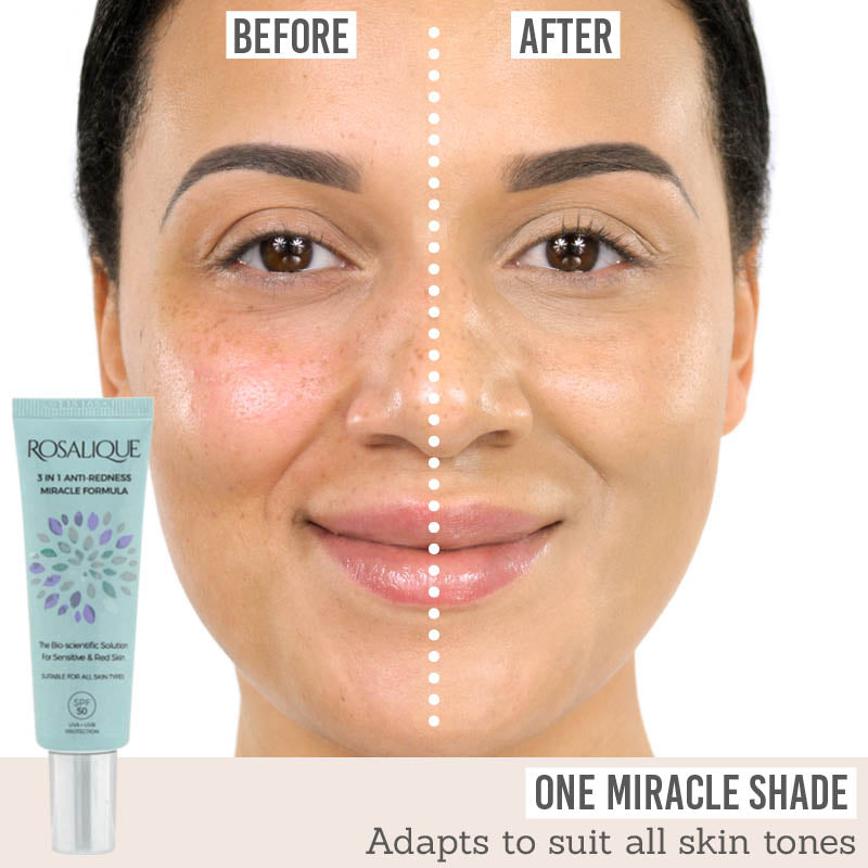 Rosalique 3 in 1 Anti Redness Miracle Formula before and after results